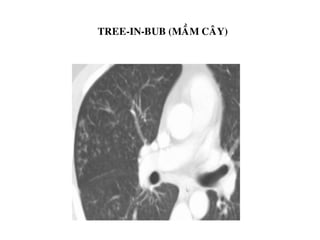 TREE-IN-BUB (MAÀM CAÂY)
 