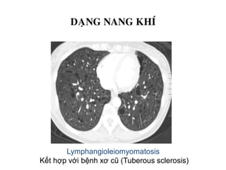 DAÏNG NANG KHÍ
Lymphangioleiomyomatosis
Kết hợp với bệnh xơ cũ (Tuberous sclerosis)
 