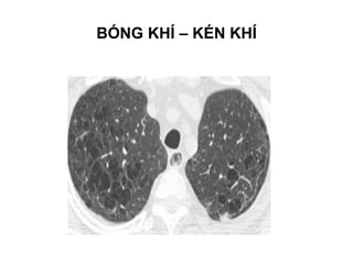 BÓNG KHÍ – KÉN KHÍ
 