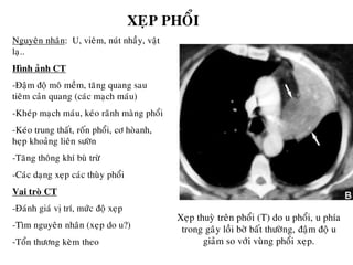Nguyeân nhaân: U, vieâm, nuùt nhaày, vaät
laï..
Hình aûnh CT
-Ñaäm ñoä moâ meàm, taêng quang sau
tieâm caûn quang (caùc maïch maùu)
-Kheùp maïch maùu, keùo raõnh maøng phoåi
-Keùo trung thaát, roán phoåi, cô hoøanh,
heïp khoaûng lieân söôøn
-Taêng thoâng khí buø tröø
-Caùc daïng xeïp caùc thuøy phoåi
Vai troø CT
-Ñaùnh giaù vò trí, möùc ñoä xeïp
-Tìm nguyeân nhaân (xeïp do u?)
-Toån thöông keøm theo
XEÏP PHOÅI
Xeïp thuyø treân phoåi (T) do u phoåi, u phía
trong gaây loài bôø baát thöôøng, ñaäm ñoä u
giaûm so vôùi vuøng phoåi xeïp.
 