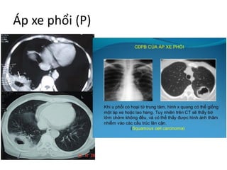 Áp xe phổi (P)
 