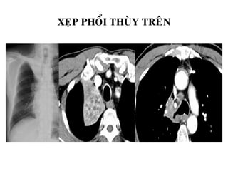 XEÏP PHOÅI THUØY TREÂN
 