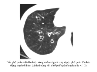 Daõn pheá quaûn vôùi daáu hieäu voøng nhaãn (signet ring sign): pheá quaûn lôùn hôn
ñoäng maïch ñi keøm (bình thöôøng khi tæ soá pheá quaûn/maïch maùu < 1.2)
 