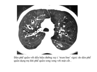 Daõn pheá quaûn vôùi daáu hieäu ñöôøng ray ( ‘tram line’ sign): do daõn pheá
quaûn daïng truï khi pheá quaûn song song vôùi maët caét .
 