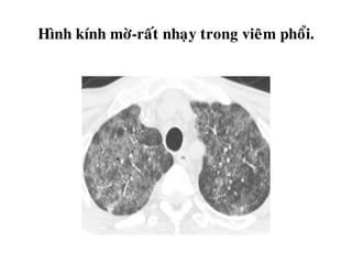 Hình kính môø-raát nhaïy trong vieâm phoåi.
 