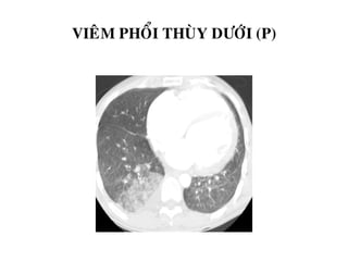 VIEÂM PHOÅI THUØY DÖÔÙI (P)
 