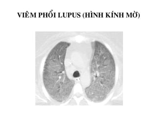 VIEÂM PHOÅI LUPUS (HÌNH KÍNH MÔØ)
 