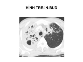 HÌNH TRE-IN-BUD
 