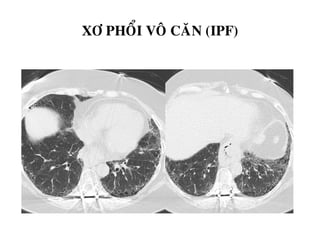 XÔ PHOÅI VOÂ CAÊN (IPF)
 