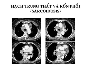 HAÏCH TRUNG THAÁT VAØ ROÁN PHOÅI
(SARCOIDOSIS)
 