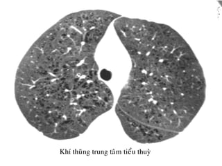 Khí thuõng trung taâm tieåu thuyø
 