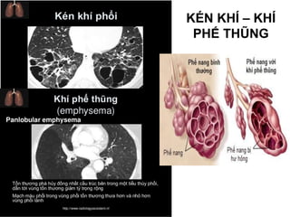 KÉN KHÍ – KHÍ
PHẾ THŨNG
 