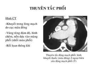 THUYEÂN TAÉC PHOÅI
Hình CT
-Khuyeát trong loøng maïch
do cuïc maùu ñoâng
-Vuøng taêêng ñaäm ñoä, hình
cheâm, neàn döïa vaøo maøng
phoåi (nhoài maùu phoåi)
-Roái loïan thoâng khí
Thuyeân taéc ñoäng maïch phoåi: hình
khuyeát thuoác (maùu ñoâng) ôû ngoaïi bieân
cuûa ñoäng maïch phoåi (T)
 