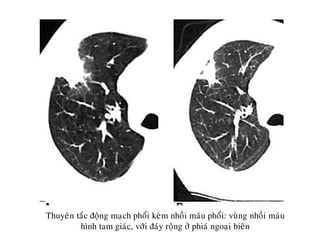 Thuyeân taéc ñoäng maïch phoåi keøm nhoài maùu phoåi: vuøng nhoài maùu
hình tam giaùc, vôùi ñaùy roäng ôû phiaù ngoaïi bieân
 