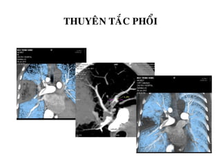 THUYEÂN TAÉC PHOÅI
 
