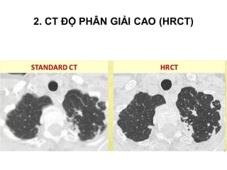 
Látcắt mỏng:1
-
‐
1
.
3
m
m

Chohình ảnhcó độphângiải cao:mạchmáu,phế
nang,môkẽ,đường dẫnkhí

Khôngtiêmcảnquang
2. CT ĐỘ PHÂN GIẢI CAO (HRCT)
 