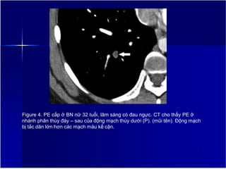 Figure 4. PE cấp ở BN nữ 32 tuổi, lâm sàng có đau ngực. CT cho thấy PE ở
nhánh phân thùy đáy – sau của động mạch thùy dưới (P). (mũi tên). Động mạch
bị tắc dãn lớn hơn các mạch máu kế cận.
6
 