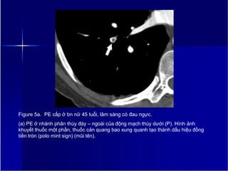 Figure 5a. PE cấp ở bn nữ 45 tuổi, lâm sàng có đau ngực.
(a) PE ở nhánh phân thùy đáy – ngoài của động mạch thùy dưới (P). Hình ảnh
khuyết thuốc một phần, thuốc cản quang bao xung quanh tạo thành dấu hiệu đồng
tiền tròn (polo mint sign) (mũi tên).
7
 