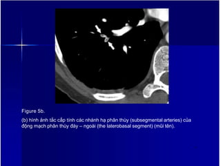 Figure 5b.
(b) hình ảnh tắc cấp tính các nhánh hạ phân thùy (subsegmental arteries) của
động mạch phân thùy đáy – ngoài (the laterobasal segment) (mũi tên).
8
 