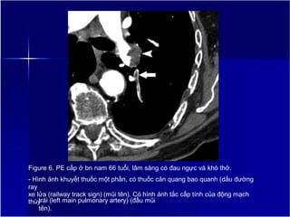Figure 6. PE cấp ở bn nam 66 tuổi, lâm sàng có đau ngực và khó thở.
- Hình ảnh khuyết thuốc một phần, có thuốc cản quang bao quanh (dấu đường
ray
xe lửa (railway track sign) (mũi tên). Có hình ảnh tắc cấp tính của động mạch
thùy
trái (left main pulmonary artery) (đầu mũi
tên).
 