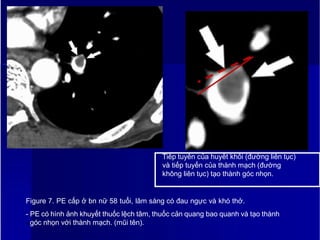 Tiếp tuyến của huyết khối (đường liên tục)
và tiếp tuyến của thành mạch (đường
không liên tục) tạo thành góc nhọn.
Figure 7. PE cấp ở bn nữ 58 tuổi, lâm sàng có đau ngực và khó thở.
- PE có hình ảnh khuyết thuốc lệch tâm, thuốc cản quang bao quanh và tạo thành
10góc nhọn với thành mạch. (mũi tên).
 