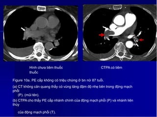Hình chưa tiêm thuốc CTPA có tiêm
thuốc
Figure 10a. PE cấp không có triệu chứng ở bn nữ 87 tuổi.
(a) CT không cản quang thấy có vùng tăng đậm độ nhẹ bên trong động mạch
phổi
(P). (mũi tên).
(b) CTPA cho thấy PE cấp nhánh chính của động mạch phổi (P) và nhánh liên
thùy
1
3
của động mạch phổi (T).
 