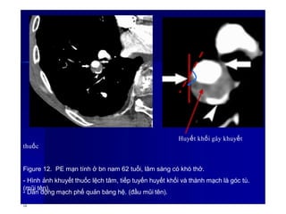 Huyết khối gây khuyết
thuốc
Figure 12. PE mạn tính ở bn nam 62 tuổi, lâm sàng có khó thở.
- Hình ảnh khuyết thuốc lệch tâm, tiếp tuyến huyết khối và thành mạch là góc tù.
(mũi tên).
- Dãn động mạch phế quản bàng hệ. (đầu mũi tên).
16
 