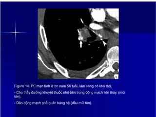 Figure 14. PE mạn tính ở bn nam 56 tuổi, lâm sàng có khó thở.
- Cho thấy đường khuyết thuốc nhỏ bên trong động mạch liên thùy. (mũi
tên).
- Dãn động mạch phế quản bàng hệ (đầu mũi tên). 17
 