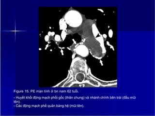 Figure 15. PE mạn tính ở bn nam 62 tuổi.
- Huyết khối động mạch phổi gốc (thân chung) và nhánh chính bên trái (đầu mũi
tên).
- Các động mạch phế quản bàng hệ (mũi tên).
18
 