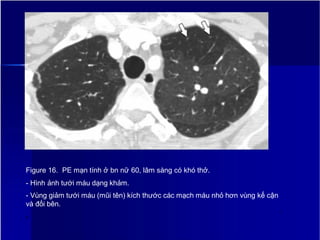 Figure 16. PE mạn tính ở bn nữ 60, lâm sàng có khó thở.
- Hình ảnh tưới máu dạng khảm.
- Vùng giảm tưới máu (mũi tên) kích thước các mạch máu nhỏ hơn vùng kế cận
và đối bên.
1
9
 