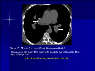 Figure 17. PE mạn ở bn nam 62 tuổi, lâm sàng có khó thở.
- Hình ảnh vôi hóa thành động mạch phổi. Dấu hiệu thứ phát của tắc động
mạch phổi mạn tính.
(cần kết hợp lâm sàng và chẩn đoán phân biệt…)
2
0
 