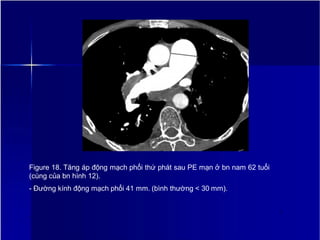 Figure 18. Tăng áp động mạch phổi thứ phát sau PE mạn ở bn nam 62 tuổi
(cùng của bn hình 12).
- Đường kính động mạch phổi 41 mm. (bình thường < 30 mm).
2
1
 