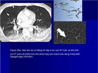 Figure 20a. Xảo ảnh do cử động hô hấp ở bn nam 61 tuổi, có khó thở.
(a) CT (cửa sổ phổi) hình ảnh phức hợp các mạch máu dạng mòng biển
(seagull sign) (mũi tên).
2
4
 