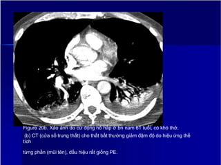 Figure 20b. Xảo ảnh do cử động hô hấp ở bn nam 61 tuổi, có khó thở.
(b) CT (cửa sổ trung thất) cho thất bất thường giảm đậm độ do hiệu ứng thể
tích
2
5
từng phần (mũi tên), dấu hiệu rất giống PE.
 