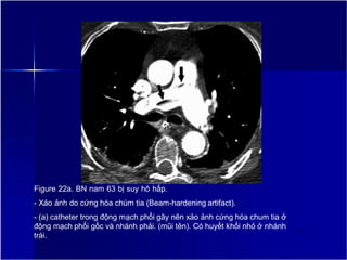 Figure 22a. BN nam 63 bị suy hô hấp.
- Xảo ảnh do cứng hóa chùm tia (Beam-hardening artifact).
- (a) catheter trong động mạch phổi gây nên xảo ảnh cứng hóa chum tia ở
động mạch phổi gốc và nhánh phải. (mũi tên). Có huyết khối nhỏ ở nhánh
trái.
27
 