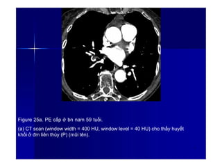 Figure 25a. PE cấp ở bn nam 59 tuổi.
(a) CT scan (window width = 400 HU, window level = 40 HU) cho thấy huyết
khối ở đm liên thùy (P) (mũi tên).
3
1
 