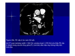 Figure 25b. PE cấp ở bn nam 59 tuổi.
(b) CT scan (window width = 552 HU, window level = 276 HU) cho thấy PE cấp
ở nhánh trong của đm thùy giữa (P). (mũi tên) dấu hiệu này không thấy trên
hình 25a.
3
2
 