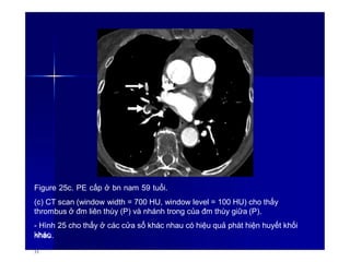 Figure 25c. PE cấp ở bn nam 59 tuổi.
(c) CT scan (window width = 700 HU, window level = 100 HU) cho thấy
thrombus ở đm liên thùy (P) và nhánh trong của đm thùy giữa (P).
- Hình 25 cho thấy ở các cửa sổ khác nhau có hiệu quả phát hiện huyết khối
khác
nhau.
33
 