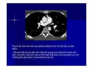 Figure 26. Xảo ảnh dải sọc (streak artifact) ở bn nữ 35 tuổi, có đau
ngực.
- Xảo ảnh dải sọc do đậm độ chất cản quang cao trong tĩnh mạch chủ
trên. (mũi tên). Xảo ảnh này có thể nhận biết được do hướng lan và vị trí
“không phải giải phẩu” (nonanatomic) của nó.
34
 