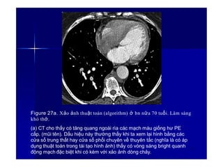 Figure 27a. Xảo ảnh thuật toán (algorithm) ở bn nữa 70 tuổi. Lâm sàng
khó thở.
(a) CT cho thấy có tăng quang ngoài rìa các mạch máu giống hư PE
cấp. (mũi tên). Dấu hiệu này thường thấy khi ta xem lại hình bằng các
cửa sổ trung thất hay cửa sổ phổi chuyên về thuyên tắc (nghĩa là có áp
dụng thuật toán trong tái tạo hình ảnh) thấy có vòng sáng bright quanh
động mạch đặc biệt khi có kèm với xảo ảnh dòng chảy.
35
 