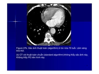 Figure 27b. Xảo ảnh thuật toán (algorithm) ở bn nữa 70 tuổi. Lâm sàng
khó thở.
(b) CT với thuật toán chuẩn (standard algorithm) không thấy xảo ảnh này.
Không thấy PE trên hình này.
36
 