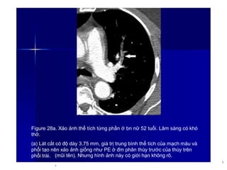 Figure 28a. Xảo ảnh thể tích từng phần ở bn nữ 52 tuổi. Lâm sàng có khó
thở.
(a) Lát cắt có độ dày 3.75 mm, giá trị trung bình thể tích của mạch máu và
phổi tạo nên xảo ảnh giống như PE ở đm phân thùy trước của thùy trên
phổi trái. (mũi tên). Nhưng hình ảnh này có giới hạn không rõ.
3
7
 