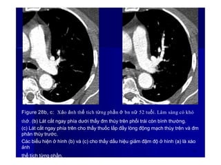 Figure 28b, c: Xảo ảnh thể tích từng phần ở bn nữ 52 tuổi. Lâm sàng có khó
thở. (b) Lát cắt ngay phía dưới thấy đm thùy trên phổi trái còn bình thường.
(c) Lát cắt ngay phía trên cho thấy thuốc lắp đầy lòng động mạch thùy trên và đm
phân thùy trước.
Các biểu hiện ở hình (b) và (c) cho thấy dấu hiệu giảm đậm độ ở hình (a) là xáo
ảnh
38
thể tích từng phần.
 