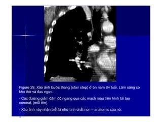 Figure 29. Xảo ảnh bước thang (stair step) ở bn nam 84 tuổi. Lâm sàng có
khó thở và đau ngực.
- Các đường giảm đậm độ ngang qua các mạch máu trên hình tái tạo
coronal. (mũi tên).
- Xảo ảnh này nhận biết là nhờ tính chất non – anatomic của nó.
39
 