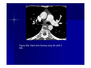 Figure 30a. Hạch bình thường vùng rốn phổi 2
bên.
40
 