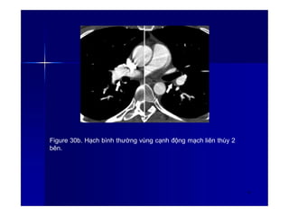 Figure 30b. Hạch bình thường vùng cạnh động mạch liên thùy 2
bên.
41
 