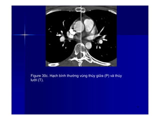 Figure 30c. Hạch bình thường vùng thùy giữa (P) và thùy
lưỡi (T).
42
 