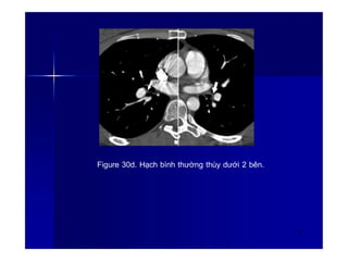 Figure 30d. Hạch bình thường thùy dưới 2 bên.
43
 