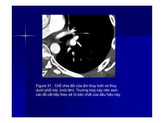 Figure 31. Chỗ chia đôi của đm thùy lưỡi và thùy
dưới phổi trái. (mũi tên). Trường hợp này nên xem
các lắt cắt tiếp theo sẽ rõ bản chất của dấu hiệu này.
44
 