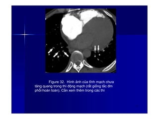 Figure 32. Hình ảnh của tĩnh mạch chưa
tăng quang trong thì động mạch (rất giống tắc đm
phổi hoàn toàn). Cần xem thêm trong các thì
45
 